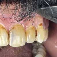 عمل حشوة ضوئية للناب والقاطع 💫  مع تحيات اخوكم د.انور فرحان 🤍  للحجز و...