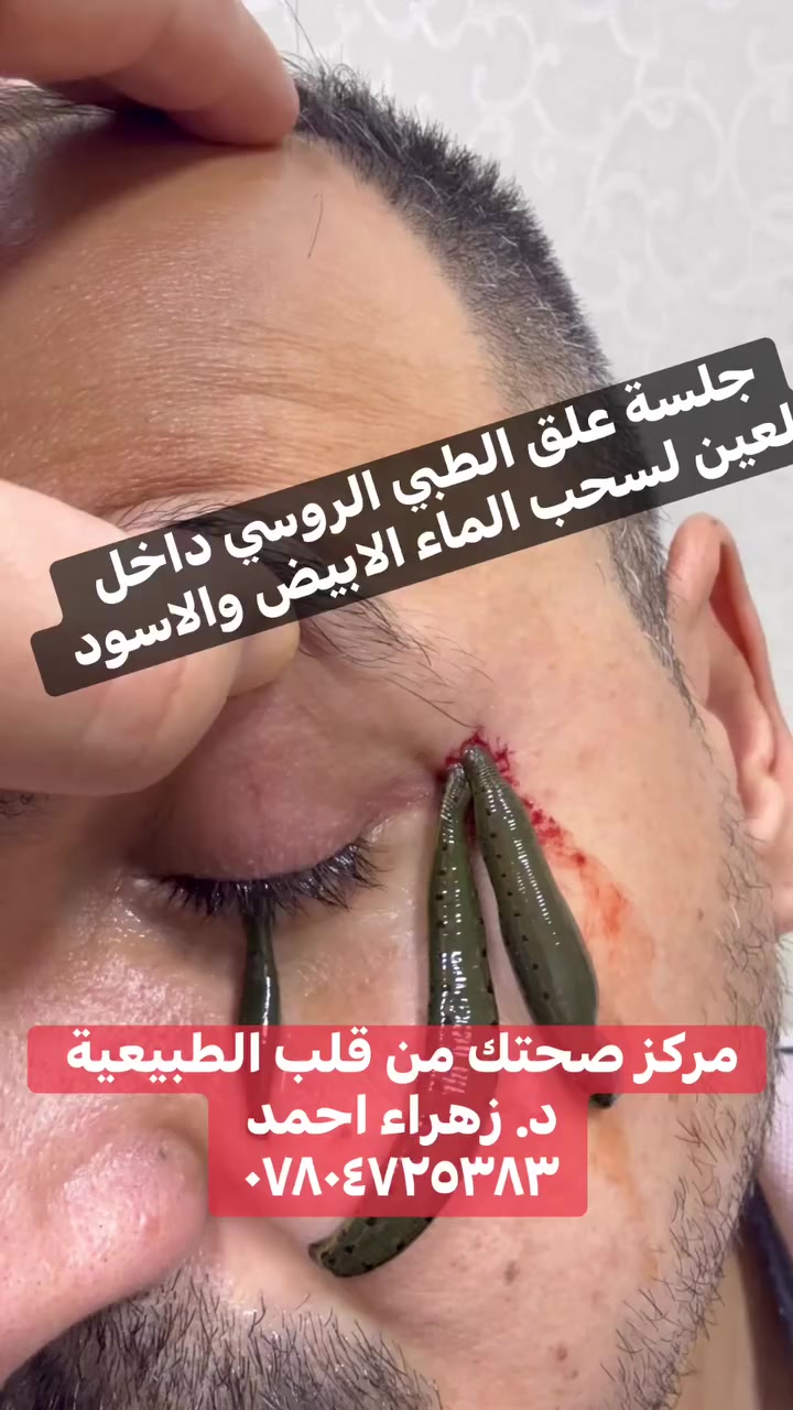 🌿 تنويه مهم حول علاج أمراض العين 👀🌿

📍نؤكد لأهلنا الكرام أن أمراض مثل الماء الأبيض (الساد) والماء الأسود (الزرق) لها بروتوكولات علاجية طبية معروفة عالمياً، يتم علاجها بوضع العلق داخل العين لا توجد من خطورة شديدة على البصر.

وتأكد 😍سلامة المريض أولويتنا الأولى، وأي إجراء علاجي يجب أن يكون آمناً ومبنياً على أسس علمية واضحة.

☘️صحتكم أمانة 
مركز صحتك من قلب الطبيعة 
بأشراف د. زهراء احمد @إشارة
كادر علمي أكاديمي رجالي ونسائي متخصص 
للحجز ***********
