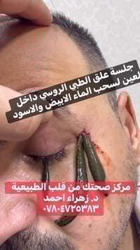 🌿 تنويه مهم حول علاج أمراض العين 👀🌿  📍نؤكد لأهلنا الكرام أن أمراض مثل ...