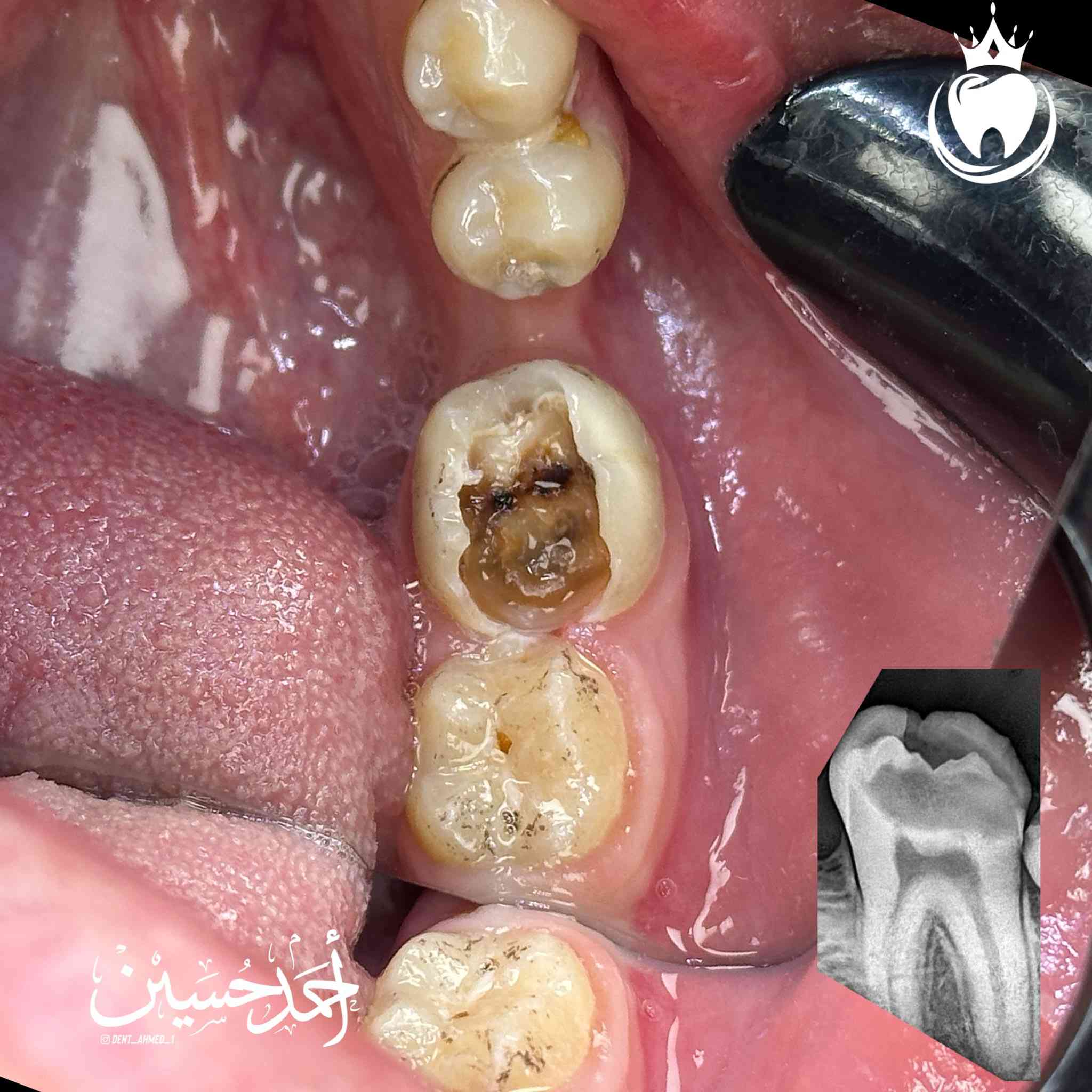 هذه الرحاة كان مصيرها القلع حسب قرار الطبيب السابق لكن قررنا نحافظ عليها كون الجزء المتبقي بعد ازالة التسوس يعتبر مناسب نوعا ما و رغبة المراجع في الحفاظ على هذا السن  و بناءََ على ذلك بدينا رحلتنا لأرجاعها الى وضعها الطبيعي😎
شرح الخطوات اسفل الصور 

الدكتور احمد حسين الطعماوي 
ناحية الزاب - المجمع الطبي الحديث مجاور مرطبات كرزة
الدوام طيلة ايام الاسبوع من الساعة ٣:٣٠ الى الساعة ٨:٠٠ مساءا
للحجز و الاستفسار : ***********
