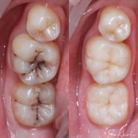 علاج مجاني • جامعة الكوفة • تنظيف أسنان