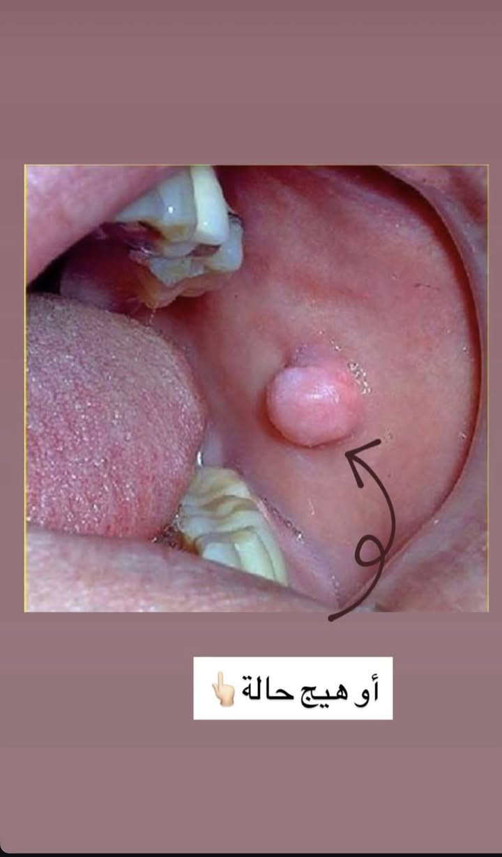 عندك هيج حالات او تعرف احد عنده هيج حالات عالجها و باسرع وقت
يكون العلاج تحت ايادي دكاتره اختصاص في كليه طب الاسنان 

لاحجز او الاستفسار عن اي حاله مراسله الرقم التالي: ***********

يكون العلاج في الزبير في عيادات كليه طب الاسنان
