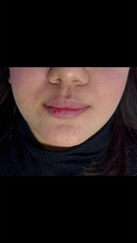 فيلر • تجميل