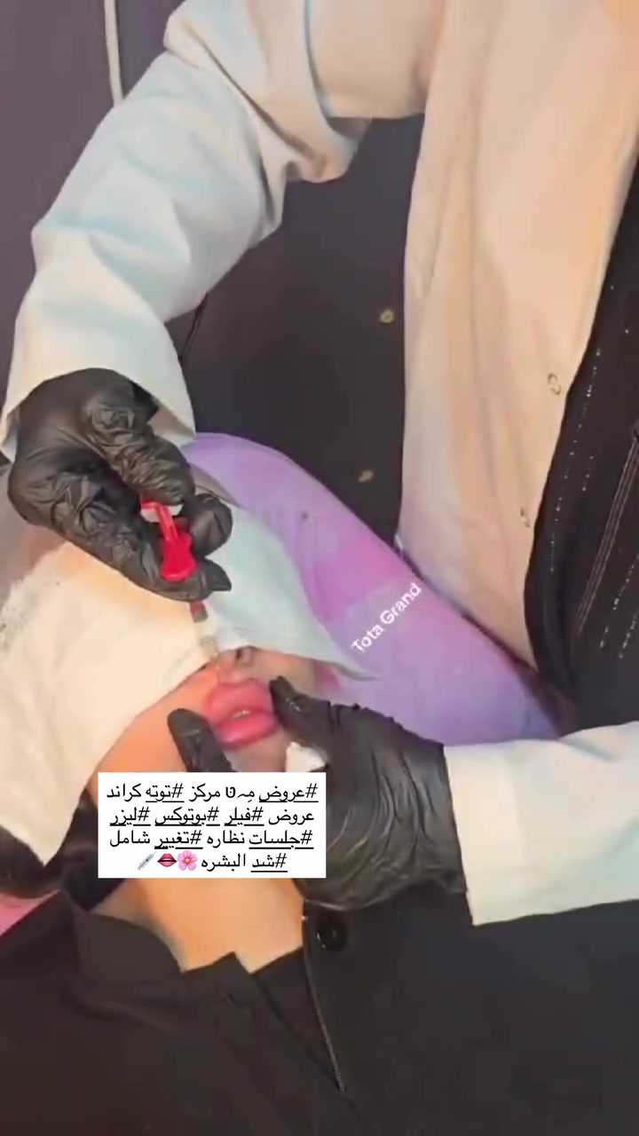 لانو جمالج يهمنه 👄💉
سوينه الكم عروض على #الفيلر
بأيد الجميله 🥹🫶🏻 توته كراند 
تم تجديد العروض باكملها
بعياده #تــდــــوته كراند.    والدكتور #كريم عبد خلف 
عرض فلر #شفه  ب٥٠ الف كل ٣اخوات ب١٢٥الف 
فلر #اراستي براند كوري 

عرض فلر #التغير الشامل ب٢٥٠ الف كل ٣ اخوات ب٦٠٠الف
فلر #اراستي براند كوري 
#بوتكس جبين ورفع حاجب وبين العينين ١٠٠ الف 
كل ٣ اخوات ٢٥٠ الف 
مكس النظاره والتبيض ابره #العجايب خاصه بعياده تــდــــوته كراند ب١٠٠ الف كل ٣اخوات ب٢٥٠ الف 
ومتوفر انواع #للنضاره بأسعار مختلفه من ٥٠ الف لل٢٠٠ الف 
وكذالك انواع الفلرات متوفره بمختلف الاسعار والبراندات
العنوان #بسمايه الشارع العام
 مجاور اكرم تسوق فوق صيدليه احمد طارق 
#والشعب شارع عدن قرب سوق اربع الاف 
للحجز والاستفسار   ***********
تنورونا ♥️✨
