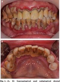 العلاج مجاني بالكامل اي احد عندة هيج تكلسات يتواصل وياية  الموقع : عيا...
