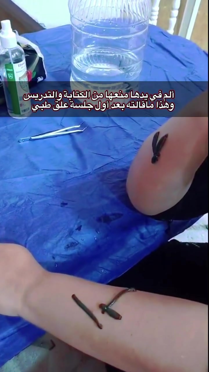 في الجلسة الثانية، دخلت هذه المعلمة وهي مبتسمة وقالت:

“والله قبل ما أجي، كنت ما أگدر أكتب على السبورة، ولا أگدر أسوي أبسط أعمال البيت من شدة ألم إيدي…

واليوم، الحمد لله، گدرت أغسل، وأشطف، وأفرم، وإيدي رجعت أحسن.”

هذه شهادة حقيقية من إحدى المراجعات بعد تجربتها مع العلق الطبي.

نسأل الله أن يتم عليها الصحة والعافية، وأن يشفي كل مريض. 🤍

⚠️ النتائج تختلف من شخص لآخر، ويُقيَّم كل مريض حسب حالته

للتواصل واتساب 
***********
