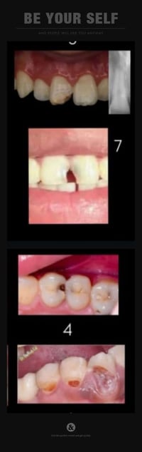 حشوة تجميلية • تسوسات • عيادات العميد السعدية