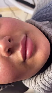 تجديد حقن • شفاه • الديوانية العروبة