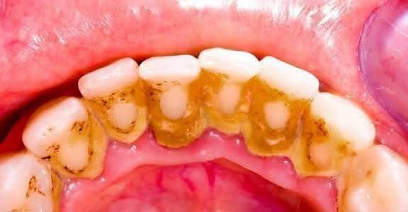 مجانا.
قلع الاسنان التالفه والجذور المتبقيه
حشوات ضوئيه تجميليه 
تنضيف الاسنان 
طقم اسنان متحرك جزئي
علما ان العلاج مجاني 
للتواصل الاتصال على الرقم التالي او التواصل على الواتساب ***********
