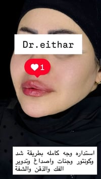 استدارة الوجه • شد بالفلر • فلر كوري