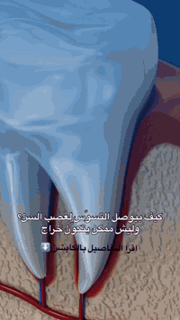 القصة تبدأ بتسوّس بسيط ... نقطة صغيرة يمكن ما نحس فيها.🫢  لكن مع الوقت...