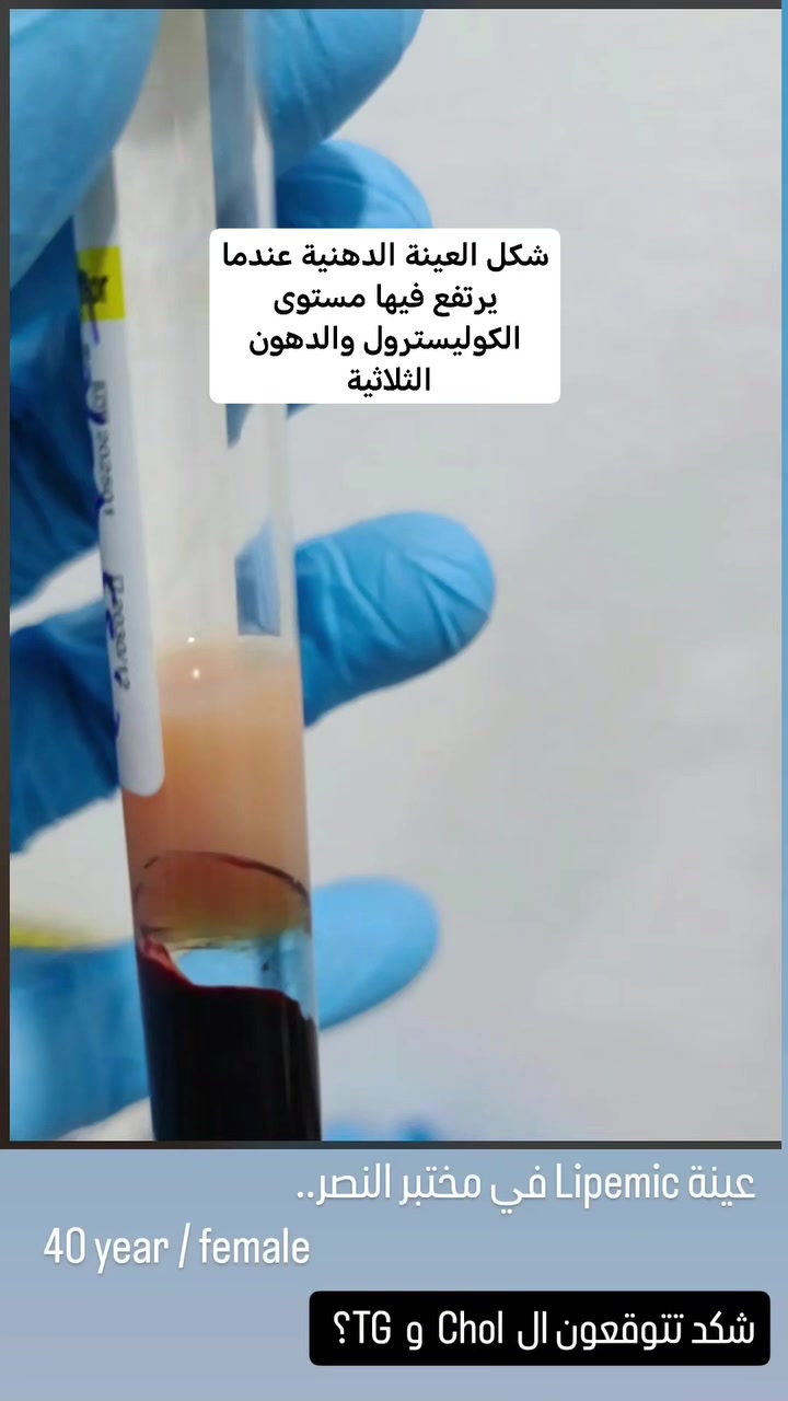 يوفر مختبر النصر فحص ملف الدهون الشامل والذي يتضمن:
فحص الكوليسترول الكلي TC
فحص الدهون الثلاثية  TG
فحص الدهون المفيدة HDL
فحص الدهون الضارة LDL
فحص الدهون الضارة جدا VLDL

يوفر الفحص صورة شاملة عن نسبة الدهون في الجسم وبالتالي فرصة تجنب أمراض السمنة والسكري وأمراض القلب وتصلب الشرايين 🩸

يتطلب الفحص الصيام لمدة 8 ساعات قبل سحب الدم 💉 
سعر الفحص 10 الاف دينار فقط 😍

النصر / بانزين خانة - قرب مول جوهرة العرب
***********
***********

