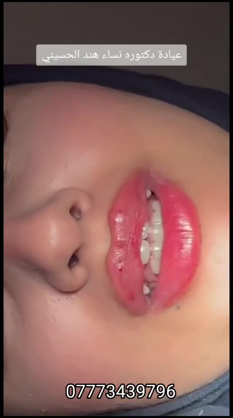 مراجعينا العيد هل مره غيررر 😍🔥
عروض قوية بقسم التجميل والأسنان بعيادة د. هند الحسيني ✨
💉 فلر
💉 بوتوكس
✨ بشرة زجاجية ولمعة تخبل
👑 تغير شامل يطلعج غير شكل
😁 تنظيف وتبييض أسنان
✨ ابتسامة هوليود
وكل هذا بأسعار وعروض العيد 🔥
شغل ناعم وفخم ونتايج تفتح النفس 🤍
الامين الثانيه/تقاطع الزهور/شارع المهداوي/مقابل عيادة النبأ
***********
