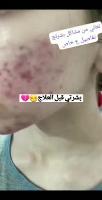 مجموعة حب الشباب • علاج نهائي • توصيل بغداد