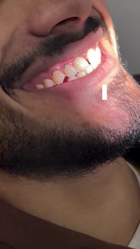 ابتسامة متناسقة بدون تقويم بدون ألم غلق فراغات الأسنان الأمامية ✨ لأن ...