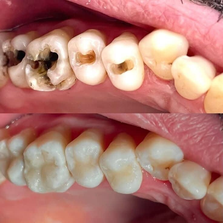السلام عليكم ورحمة الله وبركاته 
جزء بسيط من عمل العيادة 
بادارة الدكتوره ايلاف عبدالوهاب صادق 
اخصائيه جراحة الفم والأسنان وسيرتفكت في مجال التجميل 
قلع الاسنان /تركيب الاسنان الثابته /حشوات بانواعها/تنظيف الاسنان / حقن بلازما للرأس والبشره وايضا حقن الفلر والبوتكس مواد اصليه مع الضمان الحقيقي في العمل 

موقع العيادة بغداد شارع جزيرة بغداد السياحيه تعبر الباب الاول تجيك فلكه اول متعبر الفلكه يجيك فرع عليمين بعمارة مكتب الفياض 
الدوام كل الايام عدا يوم الجمعه ومن الساعه الرابعه عصرا الى تمام الساعه التاسعه مسائا وبخدمة الجميع 
للاستفسار ***********
