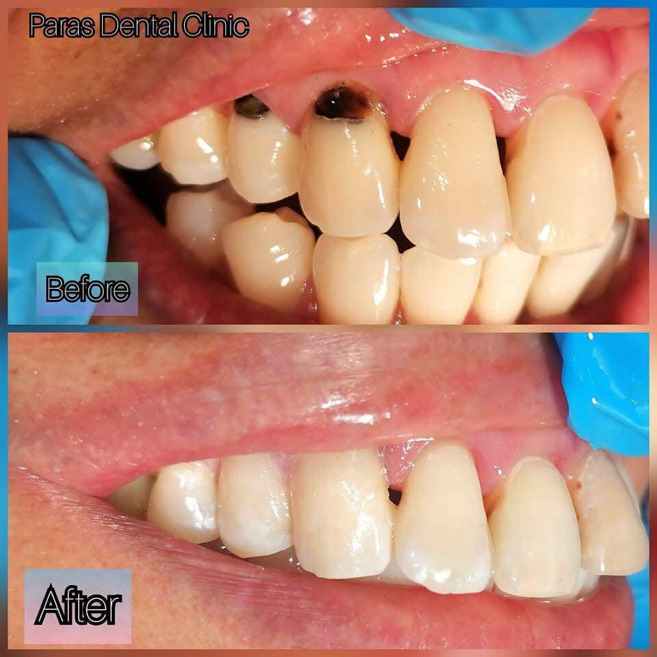 اي احد محتاج حشوة ضؤية نفس الصورة يراسلني علما ان المعالجة مجانية ولفترة محدودة للحجز ***********
