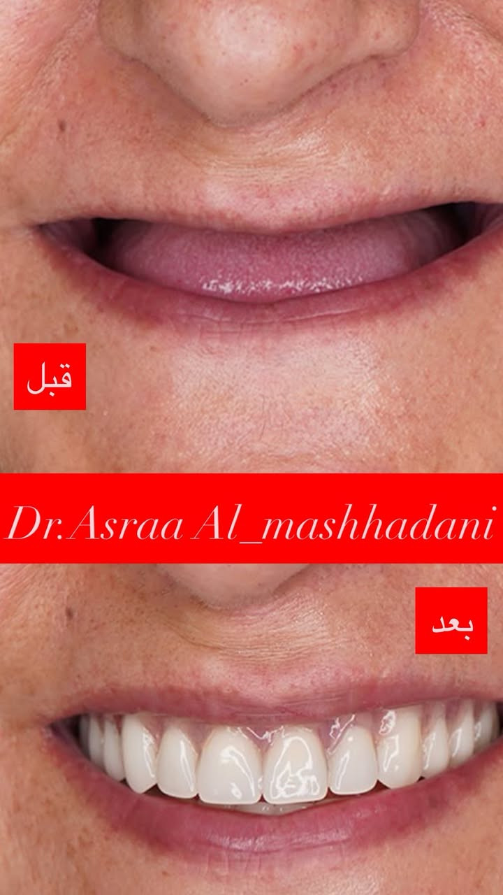 السلام عليكم اللي عدهم فقدان بأسنانهم كما هو موضح بالصور ادناه ⬇️ الحل صار موجود بطقم كامل للاسنان  وصار (العلاج مجاناً) ولا نحتاج فقط الدعاء منكم متواجدين يوميا عدا يوم الخميس في (عيادات كلية الرشيد ) بغداد_ حي الحسين مقابل محطة وقود حي العامل

اللي يحب يستفسر يتواصل وياية حتى نرتب مواعيدكم إن شـاء الـلّٰـه (***********)
