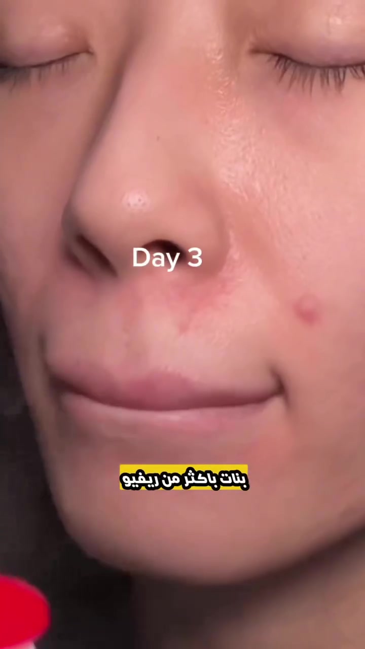 بشرتج تستاهل أحسن رعاية 💆‍♀️✨
Dr. Althea 345 Relief Cream Mist الكوري 🇰🇷 — بخاخ كريم بلمسة واحدة يعطي بشرتج ترطيب عميق بحمض الهيالورونيك وماء البحر الجليدي 🌊
ما يسوّي ثقل، ما يترك دهنية — بس نعومة وراحة من أول رشّة 🫧
✅ مناسب البشرة الجافة والمختلطة
✅ يهدئ ويقلل التهيج
✅ يخفي آثار حب الشباب
📩 السعر خاص — راسلينا!
#كريم_كوري #Dr_Althea #ترطيب_البشرة #العناية_بالبشرة


**إذا كنت صاحب هذا الإعلان وتريد حذفه لأي سبب، رجاءا أرسل رسالة إلى الدعم الفني**