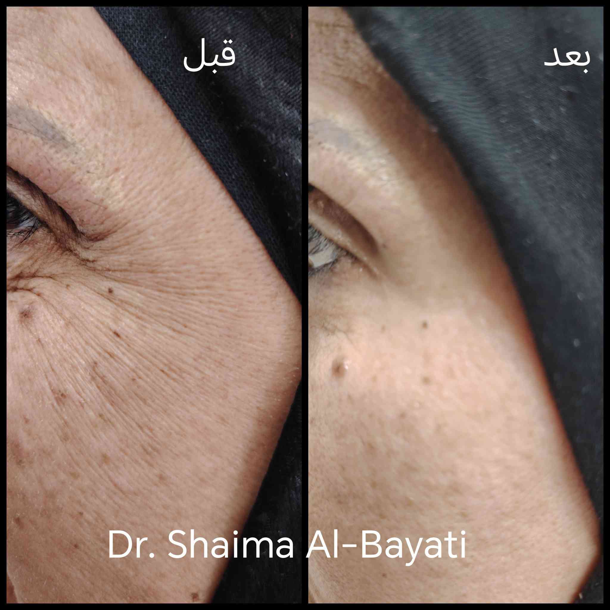 ✨ بعد الـ30… ملامحك تحچي قبل لا تحچين أنتِ ✨
مو لأن كبرتي بالعمر،
لكن لأن عضلات وجهك اشتغلت سنين طويلة
ضحك ✨ عبوس 🤍 تركيز 😌
وهاي الحركات إذا ما نوقفها بوقتها… تترك أثر دائم.
👩‍⚕️ شنو دور البوتوكس بهالعمر؟
البوتوكس مو “تغيير ملامح”
هو إجراء طبي دقيق يهدف إلى: ✔️ إرخاء العضلات المسؤولة عن التجاعيد
✔️ إيقاف تعمّق الخطوط قبل لا تصير ثابتة
✔️ الحفاظ على الكولاجين وجودة الجلد
✔️ إعطاء مظهر مرتاح، ناعم، وطبيعي
⏰ ليش مهم بهالمرحلة العمرية ما نأخر؟
🔹 بعد الـ30 والـ40 تبدأ التجاعيد تتحول من: Dynamic ➡️ Static
يعني من خطوط حركة… إلى خطوط دائمة
🔹 الدراسات أثبتت:
البوتوكس المبكّر بهالعمر يحتاج جرعات أقل
يعطي نتائج أنعم وأطول
يقلل الحاجة للفيلر أو الليزر مستقبلاً
⚠️ التأخير شنو نتائجه؟
❌ خطوط أعمق بالجبهة وبين الحاجبين
❌ تجاعيد حول العين أوضح
❌ استجابة أضعف للبوتوكس لوحده
❌ نضطر لإجراءات إضافية
🌿 الفرق مو بالكم… الفرق بالتوقيت
✔️ بوتوكس بجرعة مدروسة
✔️ بتقييم طبي حسب عمر الجلد وحركة العضلة
✔️ يعطيك مظهر أصغر بدون ما يغير هويتك
💬 الخلاصة لكل امرأة 30+ أو 40+:
مو متأخرة…
لكن كل ما بديتي أبكر وبطريقة صحيحة
كل ما حافظتي على جمالك الطبيعي لفترة أطول 💖
📩 احجزي استشارتك
وخلي التقييم الطبي يحدد:
وين؟ شكد؟ وشوكت؟ 👩‍⚕️✨

ودمتم سالمين 🌹

دكتورة شيماء أحمد البياتي
اختصاص طب أسرة

بابل الحصوة قرب كراج الدايرة القديم داخل السوق مجمع الحاج عيسى الطبي قرب صيدلية المحار
للحجز ***********
