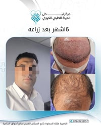 زراعة شعر • مركز نبض الحياة • الناصرية شارع الاسكان