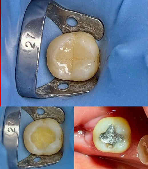 ⚡️ 30% خصم الآن!  عرض لا يُفوَّت! ⚡️

الدكتور وليد الفهداوي (بكالوريوس طب وجراحة الفم والأسنان
، سيرتفكت حشوات جذور ) يقدم :

​💰 العرض الأقوى (لفترة محدودة)!

​مجاناً: تنظيف وإزالة التكلسات والتصبغات عند حجز جلسة التبييض بالليزر!

​خصومات تصل إلى 30% على حشوات الضوئية و حشوات الجذور والقلع.

​فحص واستشارة مجانية لجميع الحجوزات.

​📞 احجز الآن!

للحجز ​اتصل على: ***********
العنوان: الرمادي _ الصوفية _ البومحل _ مجاور ملعب شهداء البومحل

