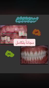 تعويض اسنان جزئي في عيادات المشرق  التكاليف مجاناً بلكامل ليوم الاثنين...