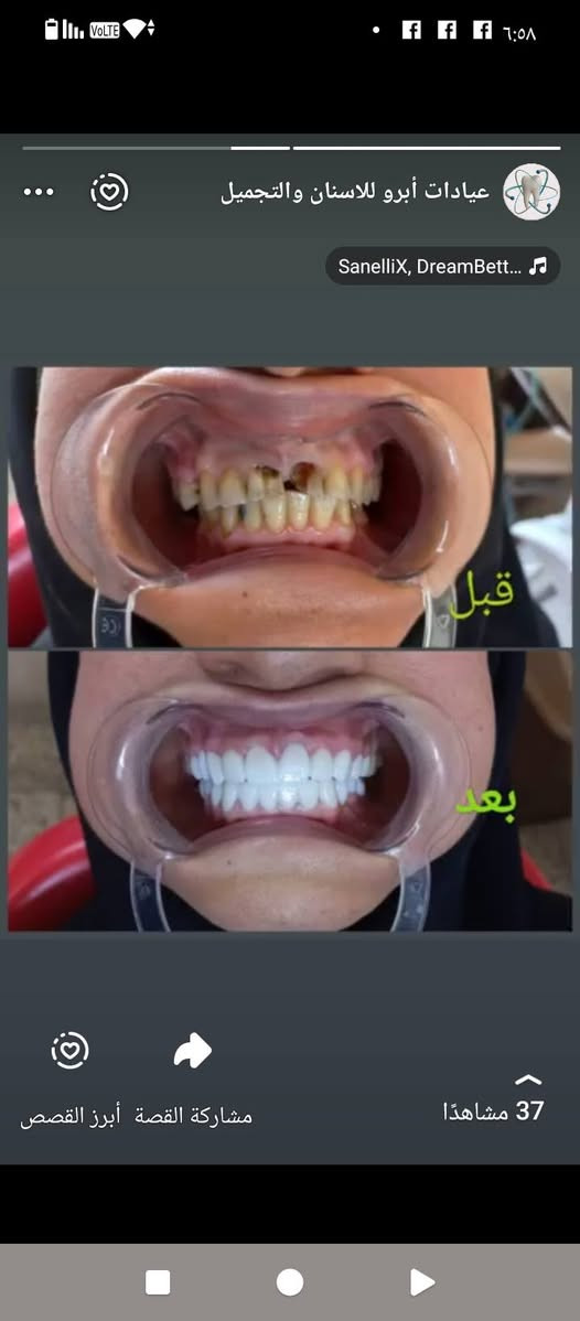 تعلن عيادات إبرو لطب الاسنان وتجميل عن عروض وتخفيضات في قسم الأسنان وتجميل مكان  العياده ماجديه نهاية شارع الجامع مقابيل مأكولات البيك ***********
