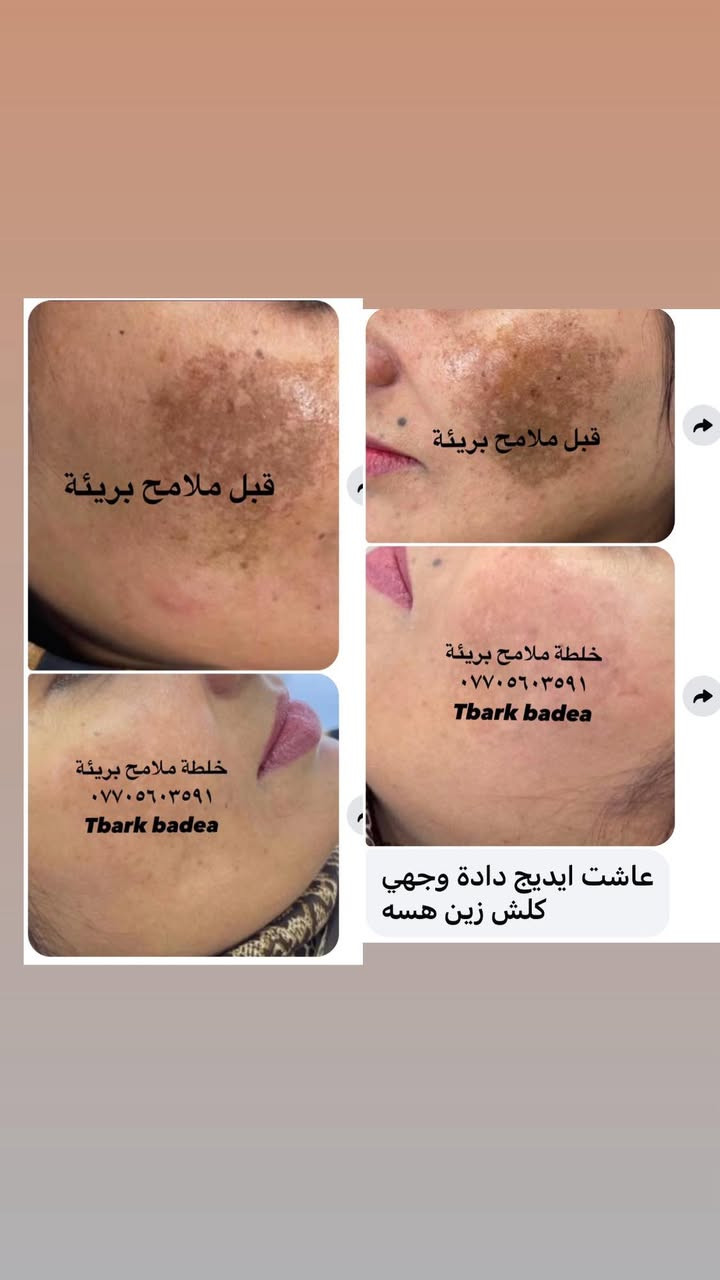 عليها القرأن الي مجربه براندي خلطة ملامح بريئة وفايدها تعلق اهنا بنات يتابعون التعليقات يردون يستخدموهاويستفسرون منكم  👈🌹


**إذا كنت صاحب هذا الإعلان وتريد حذفه لأي سبب، رجاءا أرسل رسالة إلى الدعم الفني**