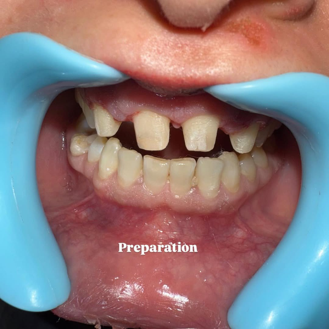 ✨ ابتسامة جديدة… ثقة أكبر ✨

من أول جلسة تگدر تشوف الفرق 👌

تركيب تجميلي يغيّر شكل الابتسامة ويعطي مظهر طبيعي وناصع 🤍

📸 الصورة تحچي عن نفسها – قبل وبعد

📍 عيادة لؤلؤة بدرة

📞 للحجز والاستفسار: ***********

ابتسامتك مسؤوليتنا 🌸

لا تتردد… خلّي ابتسامتك تحچي عنك �
