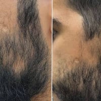 شامبو بار • منع التساقط • إنبات الشعر