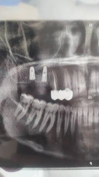 زراعة الأسنان الألمانية • عيادة الفرح • حي النصر