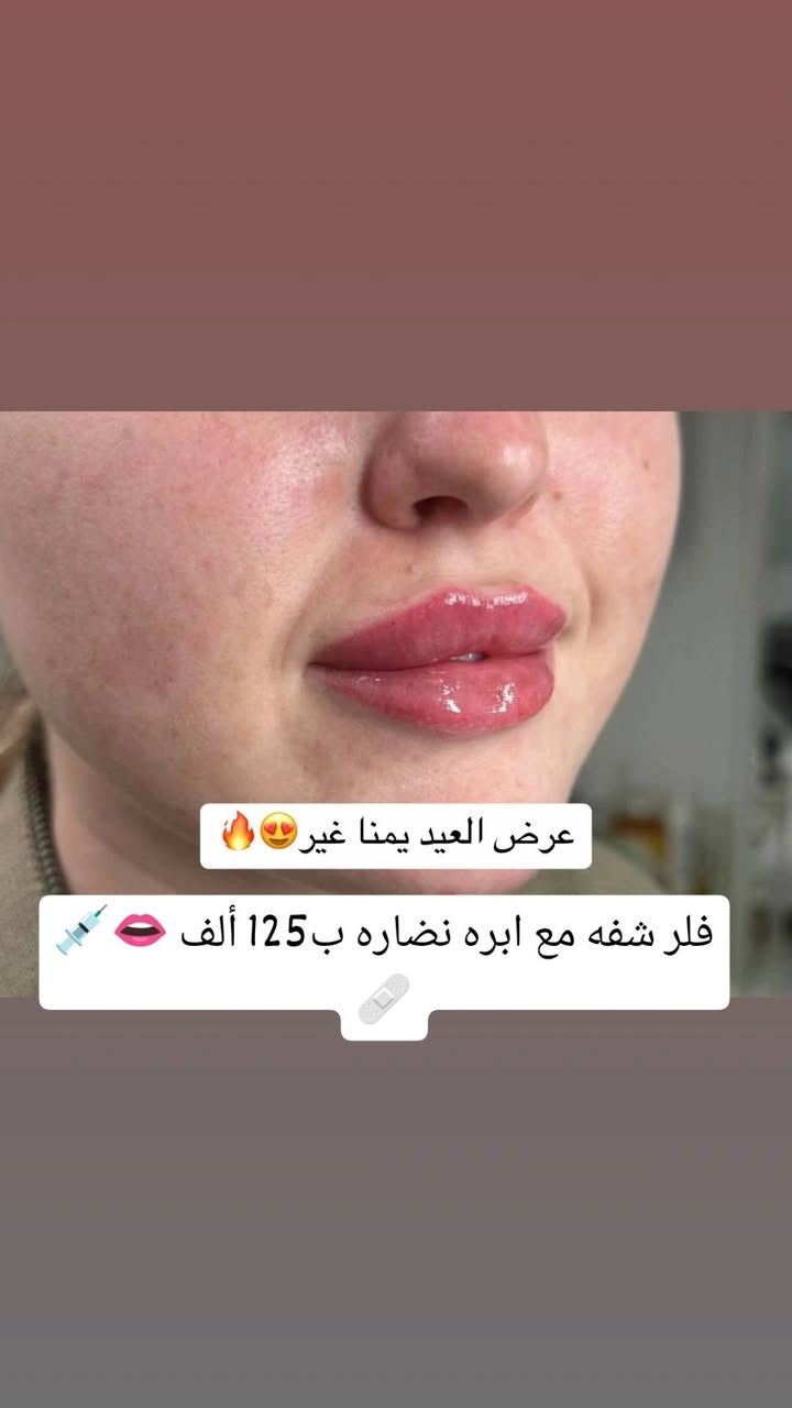 عروض العيد بمركز روز للتجميل لا تفوتوها 🔥🔥
حساب الانستا https://www.instagram.com/stories/jas1qj/3897588453466502431?utm_source=ig_story_item_share&igsh=OGszcnZxOGszcWww


**إذا كنت صاحب هذا الإعلان وتريد حذفه لأي سبب، رجاءا أرسل رسالة إلى الدعم الفني**