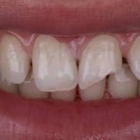 مجاناً 🔴 العنده هيج تسوسات يتواصل ع رقم   07716913889