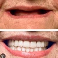 مرحبا إذا احد عنده هاي الحاله وفاقد كل اسنانه وحاب يسويهن يتواصل ويايه...