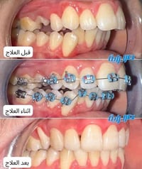 😍😍😍😍تقويم الأسنان بلقسط المريح 😍😍😍  علاج حالة تقدم الفكين وتزاحم الاسن...