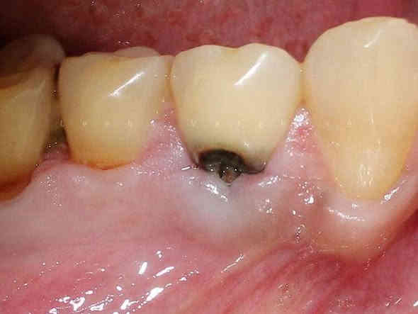 الي عندة مثل هاي الحالات ومحتاج حشوات أو قلع للاسنان والجذور المتبقية العلاج مجاني داخل عيادات جامعة واسط وبأشراف اطباء مختصين
تواصلوا وياي  عالواتساب او التليجرام 

***********
