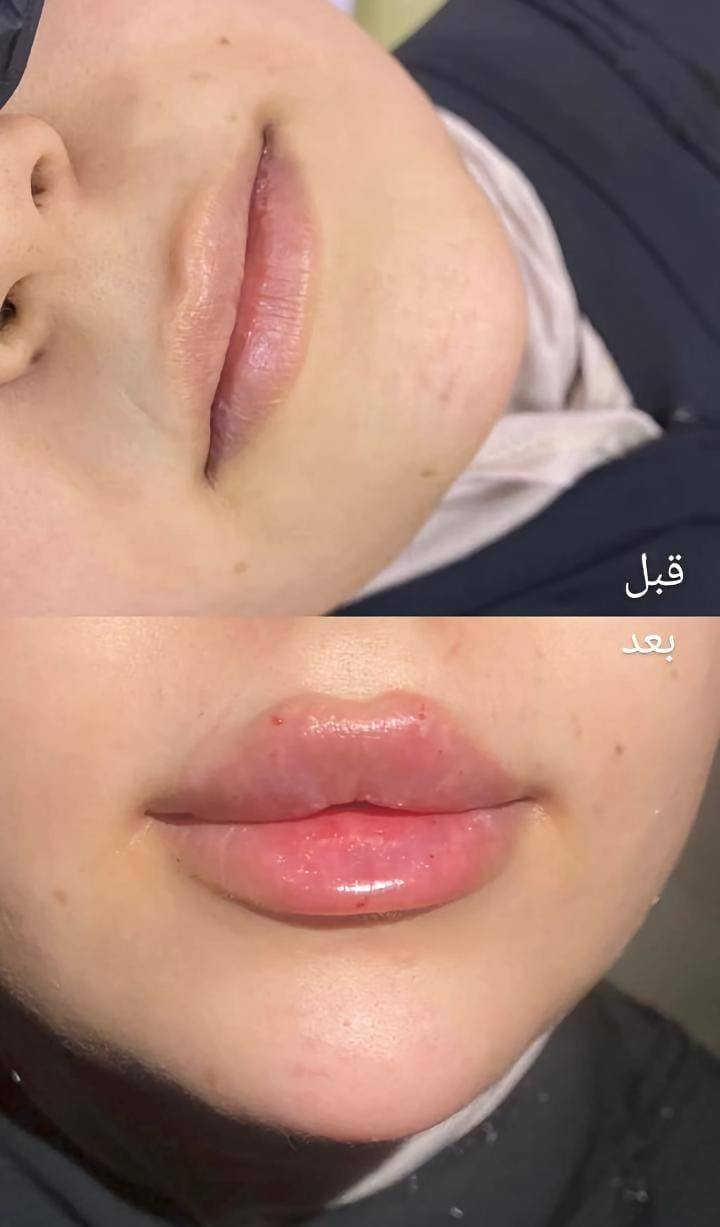 تعلن عيادات إبرو لطب الاسنان وتجميل عن عروض وتخفيضات في قسم الأسنان وتجميل مكان  العياده ماجديه نهاية شارع الجامع مقابيل مأكولات البيك ***********
