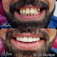 ابتسامتك تستاهل الأفضل  ❤️ عيادة أسنان السفير ❤️ #زراعة_الاسنان  #تركي...