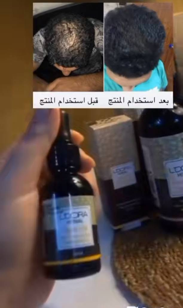 ✨منتجات والعلاج طبيعي شركة ليدورا العالميه✔️✨
♦مع الضمان لكل المنتجات والعلاج الطبيعي♦

منتجات عناية من شركة ليدورا العالميه 
منتج شعر يتكون من 5قطع علاج مضمون
💯💯
علاج كلف نمش تصبقات 
علاج تعرق الجسم 
علاج تشققات لاقدام 
علاج خشونه اليد 
علاج الجسم من جلد الوزه 
علاج براند طبيعي 
حصرن يتوفر بس يمنه 😍
من شركه عالميه عشبيه

1_للتجميل+العناية_للجسم وشعر الوجه كافة ✨

2_كل الحالات يشوفهة اخصائي او مستشار خاص للجلد وبشرة والشعر والجسم 

3_اعطاء علاج المناسب لكل حالة نستطيع علاجها- ولاكن العلاج يكون للمشاكل الخارجية فقط وليس المشاكل الداخليه 🔴

4_يتم متابعة الزبون ع مدار 4اسابيع او اكثر حتي يتم العلاج النهائي لحالة الشخص 

5_كل سبوع يوجد نادي للعملاء الي مسوقين من عدنة سابقا_واذا عدهم اي سؤال او استفسار يخص حالة معينة عدهم او اشخاص اخرين عادي جدا🔴
لذالك كل سبوع يوجد مستشار بشرة وشعر التشخيص مجانا يكون لديهم✅
 

🔴لدينا مستشارين ومستشارات خاصين للنساء والرجال🔴
    🔺يوجد توصيل لكل مناطق الكوت
#مكانه واسط_الكوت//#رقم_الهاتف: ***********
