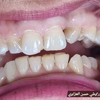 تغليف الاسنان • جسور الزاركون • جبله شارع الاطباء