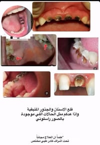قلع اسنان مجاني • تنظيف اسنان مجاني • عيادات كلية دجلة