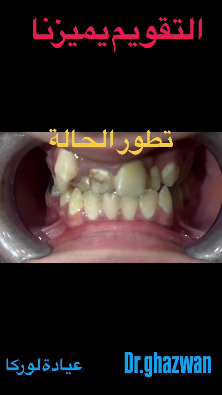 التقويم يميزنا احد اعقد و اصعب الحالات من حيث الإهمال و عدم التنظيف و التسوس المتكرر مما ادى إلى قلع السن الاماميه المتهالك و اعادة ترتيب للاسنان… علاج جميع الحالات الصعبة و المعقدة نتائج مضمونة علاج و خطط طبية متطورة تضمن النتائج المرضية و جمالية و روعة المظهر الخارجي اسعار مناسبة بالتقسيط المريح… دكتور غزوان مزهر بغداد الكرخ نفق الشرطة بداية شارع الاطباء عيادة لوركا فوق صيدلية كنز النفق متوفر واتس *********** #تقويم_الأسنان_والفكين #تقويمالأسنان #تقويم_الأسنان_بأنواعه #تقويم_الشفاف_للأسنان #تقدم_الفك_السفلي @تقويم_الاسنان @تقدم_الفك_السفلي @العضة_المعكوسة @العضة_المفتوحة
