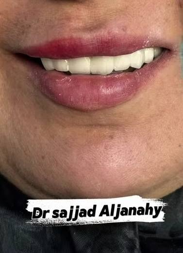 خلي ابتسامتك تبدأ ويانه! 🦷😀
تعلن عيادة الدكتور  الدكتور سجاد حسين الجناحي    Dr. Sajjad Hussain Al-janahy  عن تقديم أفضل الخدمات العلاجية والتجميلية حرصًا منا على راحتكم وصحة أسنانكم. ❤. 🦷

🔹 خدماتنا تشمل:
• تنظيف وتلميع الأسنان 🦷
• حشوات تجميلية وعلاج التسوس 🦷
• سحب العصب وعلاج الألم 🦷
• قلع الأسنان والجراحة 🦷
• تركيبات ثابتة ومتحركة 🦷
• زراعةوتقويم الاسنان 🦷
• تبييض الأسنان 🦷
• علاج لثة ونزف اللثة
• متابعة وعلاج أسنان الأطفال
وباسعار مناسبة ❤🦷

📍 العنوان: [ مجمع مجمع الحياة الطبي شارع السوداني مقابيل اسواق ابو علاء. ]
📞 للحجز والاستفسار: [***********]

🌟 لأن ابتسامتكم تهمنا… نهتم بأدق التفاصيل لنمنحكم الراحة والثقة.
 👇... 
Sajjad Al-Janahy 
دبلوم مهني تقويم الأسنان 
سيرتفيكيت زراعة الأسنان 
سيرتفيكيت تجميل الأسنان
