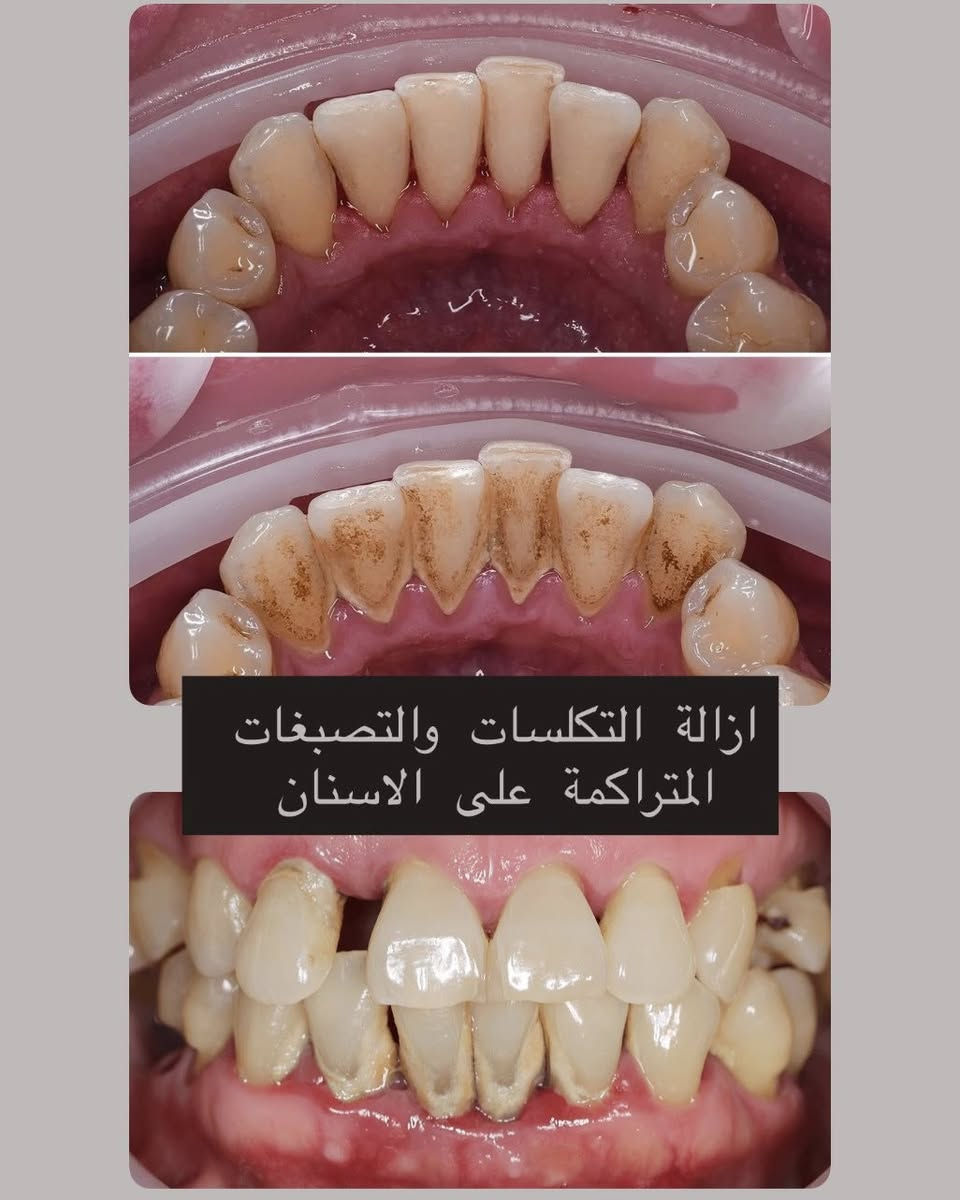 تبحث عن علاج مجاني وآمن؟✨
نلتقيكم في عياداتنا!
📅 بدأنا نستقبل الحالات في عيادات جامعة كركوك !

🔹 الخدمات المتوفرة:
 •قلع الأسنان
 •الحشوات
 •تنظيف الأسنان
 •أطقم الأسنان

سارعوا بالحجز، الحجوزات محدودة !

💌 للحجز والتفاصيل: مراسلة الصفحة او التواصل على الرقم ***********
