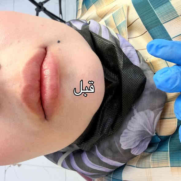 ⁨ حقن شفة بالطريقة الروسية الاوڤر لمحبين الشفاه البارزه🍒🍓
#فلر_ايطالي 
للحجز والاستفسار /***********
#الديوانية #فلر_شفايف #فلر #فلر_الشفايف #فلر_شفاه #فلر_شفة #فلر_شفايف👄 #اكسبلورر #اكسبلور_فولو #اكسبلور_explore #اكسبلور⁩
