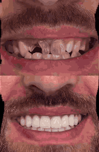 🦷ابتسامة هوليود " أبتسامة المشاهير.
🦷 هوليود سمايل متوفره بكل الانواع في مركز الابتسامة الذهبية 
🦷 الفحص والمعاينة مجانا
🦷 ابتسامة الدايركت فنير
🦷 ابتسامة  E - Max
🦷 ابتسامة V - Max
سوي الهوليود #سمايل وعيش اجواء الشهرة ضمان نتائج العمل حيث كل نوع ابتسامة لها فترة ضمان مختلفه عن الأخرى
#الدكتور_عمار_حمودة

#مركز_الابتسامة_الذهبية #Golden_smile_center. 
#العنوان : #الكوت_الخاجية_شارع_٤٠  #مقابل_فرح_الكوت
تمنياتنا للجميع دوام الصحة والعافية 
للاستفسار والحجز الاتصال على الارقام التالية:
🔹***********
🔹***********
