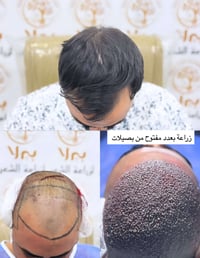 زراعة شعر • قبل وبعد • بيرلا النجف الأشرف