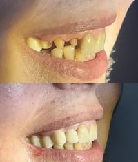 عيادة الطائي لطب الاسنان ♥️  تغليفات الزاركون بانسب صورة واحلى شكل ينا...