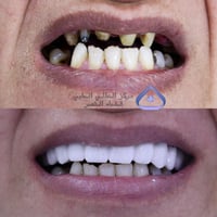 فحص مجاني • تجميل الأسنان • ذي قار النصر